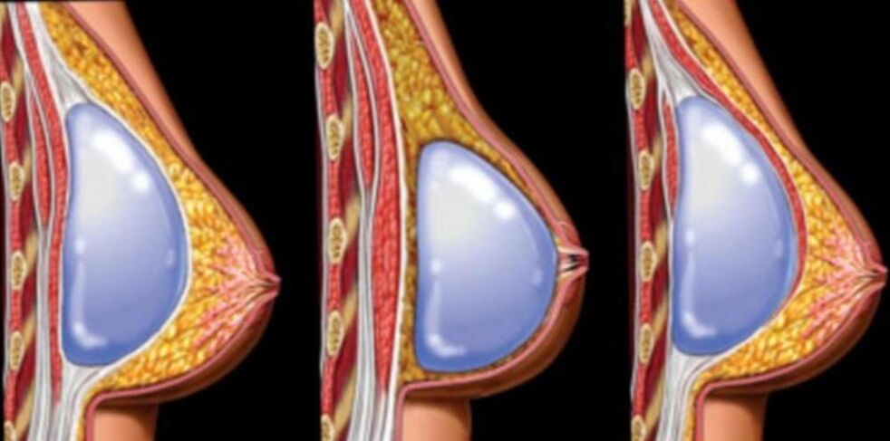 Implantatinstallation
