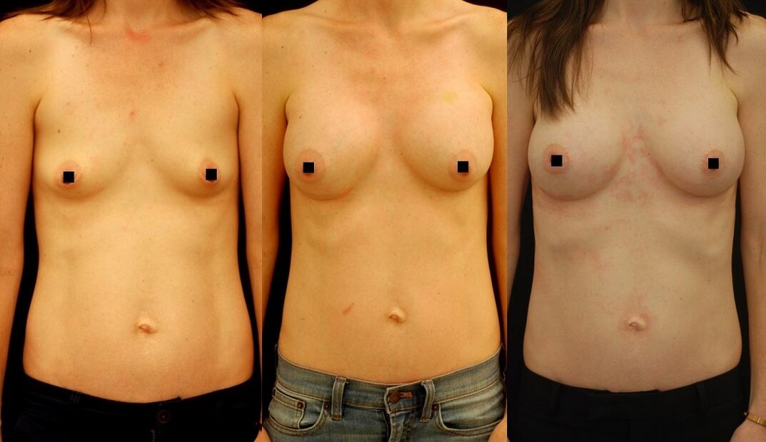 Das Ergebnis der Brustvergrößerung durch Injektion. 