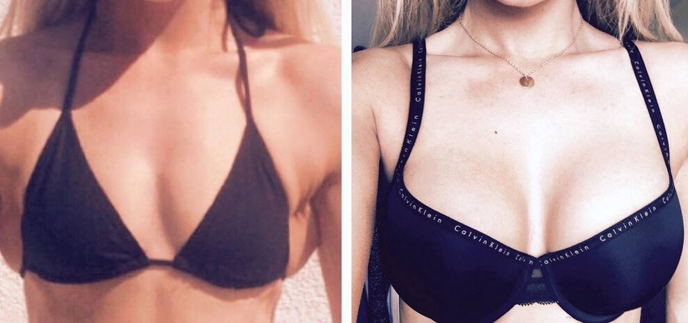 Vor und nach der Brustvergrößerung